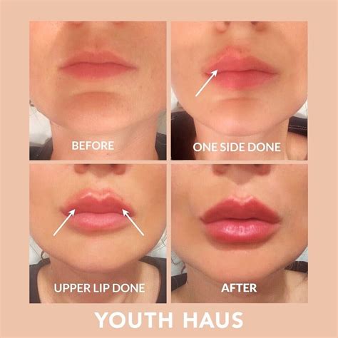 Collagen Lips Before After Pictures | Lipstutorial.org