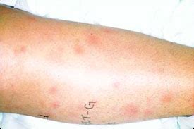 Cutaneous Sarcoidosis: A Dermatologic Masquerader | AAFP