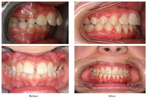 Overjet Before And After