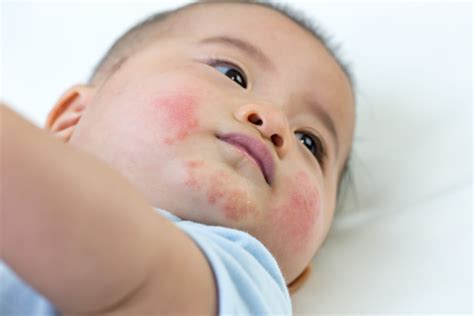 Baby Eczema Rash On Face