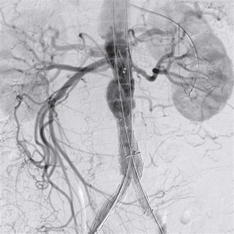 Endovascular Arterial Repair (EVAR) - Primary Anatomy