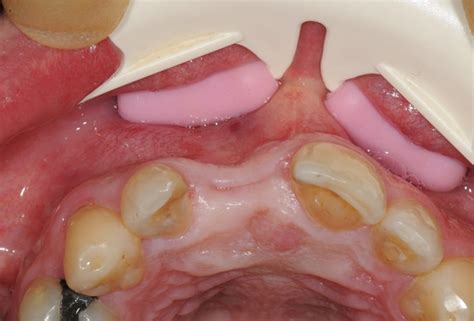 Restoration of buccal layer in aesthetic zone with maxgraft® bonering - botiss biomaterials GmbH