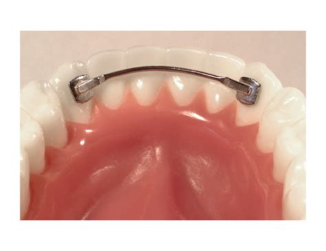 Lingual Appliances | American Orthodontics