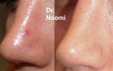 Laser vein, capillary and redness removal - Best Cosmetic Clinic Sydney ...