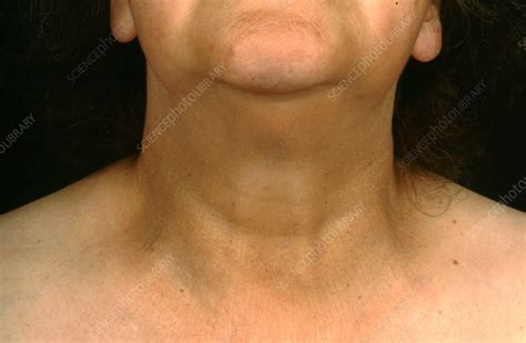 Hypothyroidism, Swollen Neck - Stock Image - C036/5590 - Science Photo Library