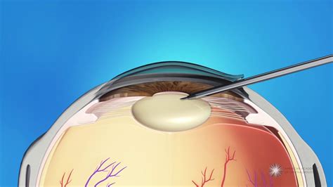 Phacoemulsification Cataract Surgery - YouTube