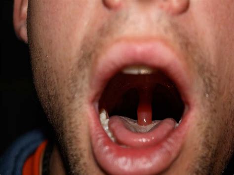 Swollen Uvula Sore Throat: Causes, Treatments and Remedies - AimDelicious