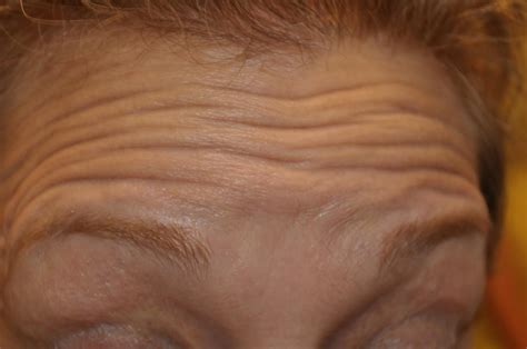 Honing In On Glabellar Furrows And Brow Crinkles With Face Aerobics: Non-Invasive Facelift ...