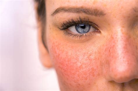 Rosacea Causes and Treatment Options