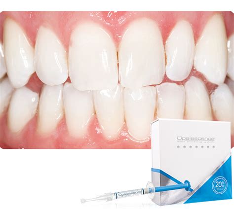 The Science Behind Teeth Whitening – Clinical Research Dental