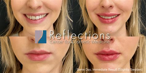 Kysse Lip Filler Immediate & Final Result Before & After Photos New Jersey - Reflections Center