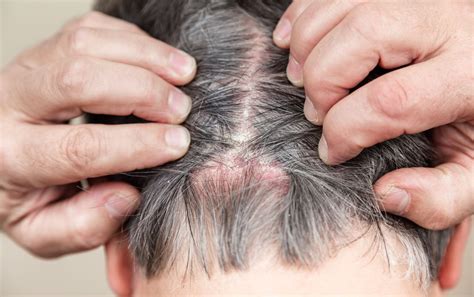 Guide To Scalp Psoriasis: Know Their Symptoms, Treatments, And Prevention