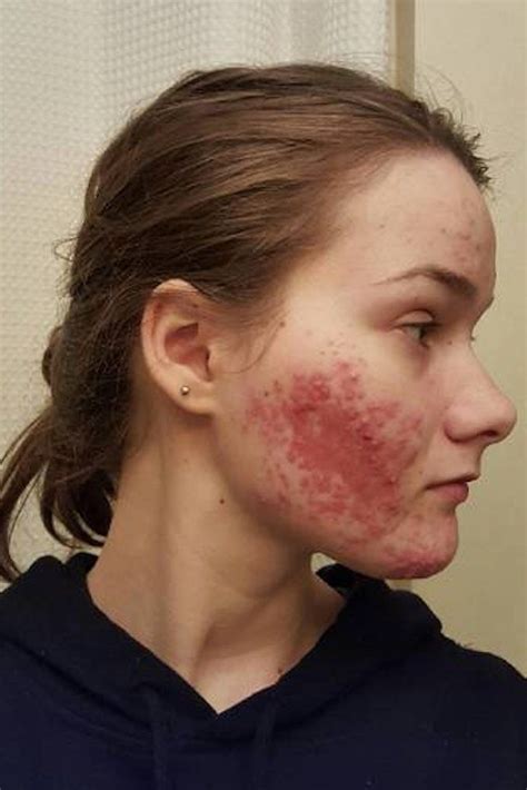 7 Real People Show How They Finally Managed Their Acne With Accutane | Natural acne treatment ...