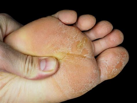 Why Your Feet and Toes are Peeling - Own Harmony