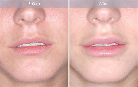 The Variation of Side Effects of Juvederm in Lips – Hannah Toby