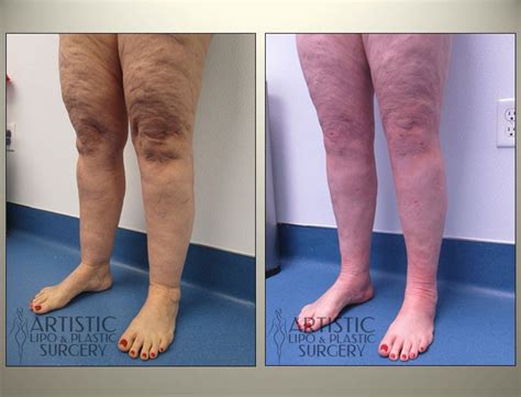 Lipedema Surgery Before and After Results - Art Lipo