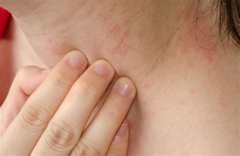 Atopic Dermatitis: Symptoms, Triggers, Causes, Treatment and More