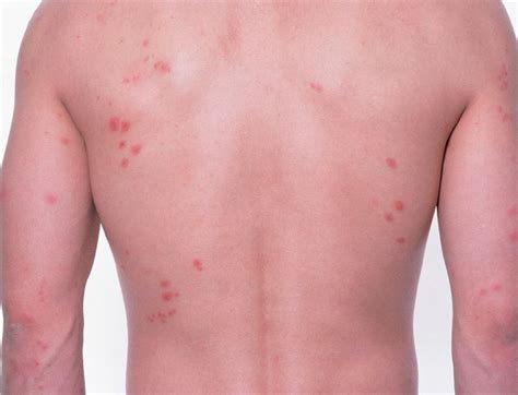 Bed Bug Bites On Person's Back Photograph by Science Photo Library