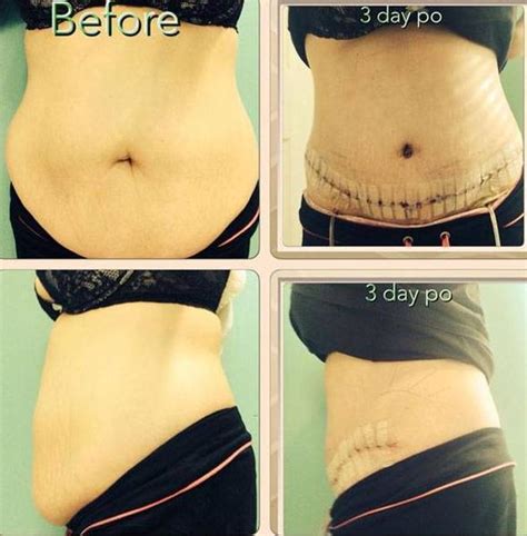 Tummy tuck scars pictures before and after » Tummy Tuck: Prices, Photos, Reviews, Info, Q&A