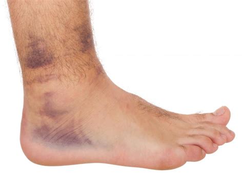 Blood Clot Symptoms Foot : DVT Treatment Glen Mills, PA | Vein Center Brinton Lake ... / For ...