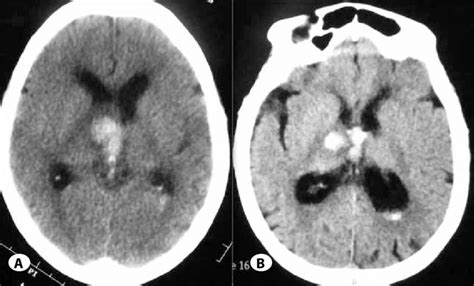 Non contrast CT scan of head showing right thalamic and IVH nine years... | Download Scientific ...