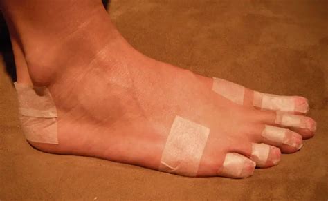 How To Avoid Blisters Under Toenail From Running: 8 Simple Tips!