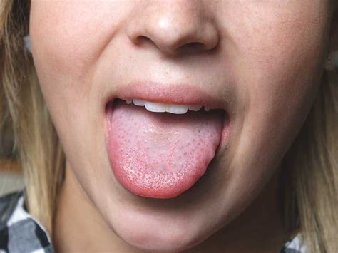 Sore Tongue? 17 Possible Causes - Healthline