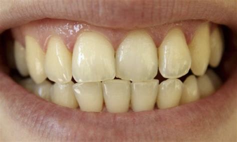 Stains on Teeth: Causes, Treatment and How to Prevent | What to wear ...