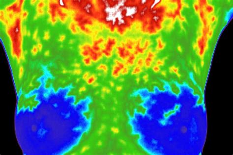 Breast Study - Choice Thermography