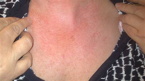 Why Am I Getting Red Rashes On My Neck - Printable Templates Protal