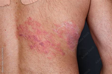 Skin lesion symptom in Shingles or Herpes zoster in human. Shingles or Herpes zoster is aviral ...