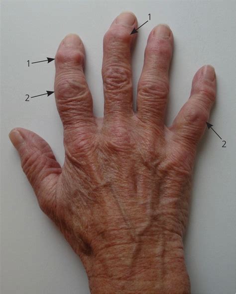 Early Osteoarthritis Hands