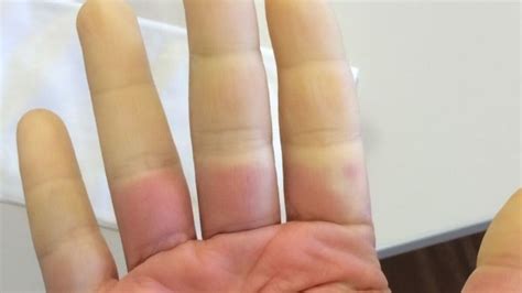 Everything You Need To Know About Raynaud's Disease