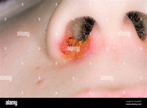 Impetigo on the nostril of the nose of a child. Impetigo is a bacterial ...