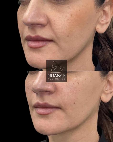 Cheek Fillers - Nuance