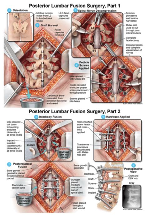 Posterior Lumbar Fusion Surgery by Sarah Faris | Spine surgery, Spinal ...