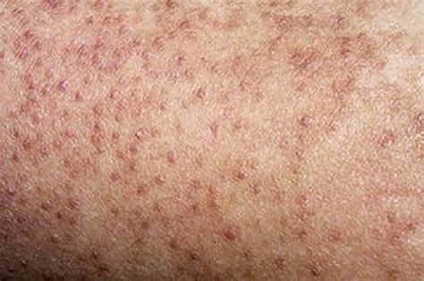 Little bumps on your thighs? Here’s how to deal with keratosis pilaris - NEWSCABAL