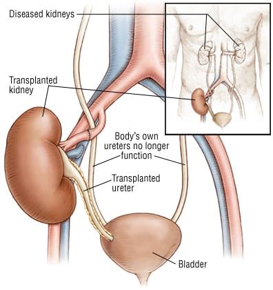 Patient Basics: Kidney Transplant | 2 Minute Medicine