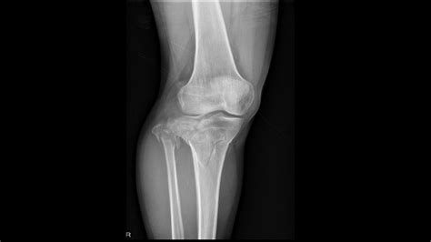 Tibial plateau fracture - wikidoc