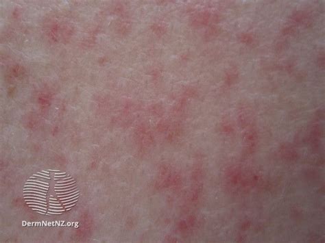 What a Leukemia Rash Is: Symptoms and How To Treat It