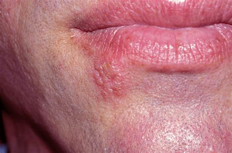 Erythema Lips | Lipstutorial.org