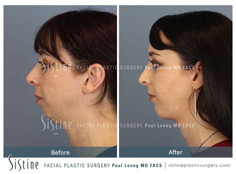 Chin Jaw And Neck Before and After 02 | Sistine Facial Plastic Surgery