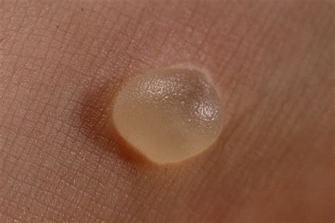 How to Treat Blisters and Deal With Recovery - HubPages