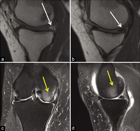 Meniscal root tears: Solving the silent epidemic - Journal of ...