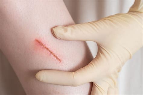 When does a wound need stitches? - Health Channel