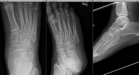 Surgical Management Navicular and Cuboid Fractures - Clinics in ...