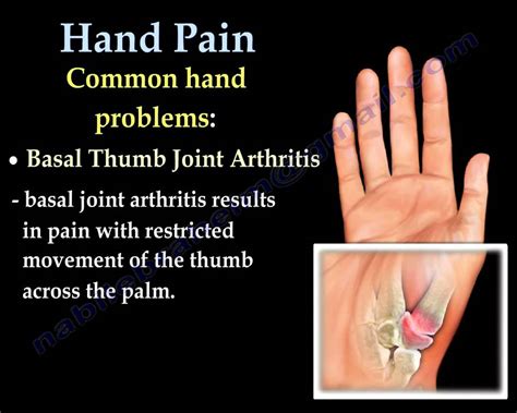 Hand Pain ,Fingers pain - Everything You Need To Know - Dr. Nabil Ebraheim - YouTube