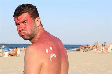 Dette skjer med huden din når du blir solbrent - Vita Pura