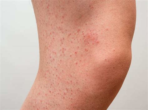 Causes And Home Remedies Of Red Spots And Bumps On Legs | Femina.in