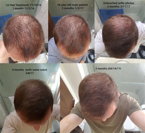 Hair Regrowth Treatment For Beard at Elaine Randall blog